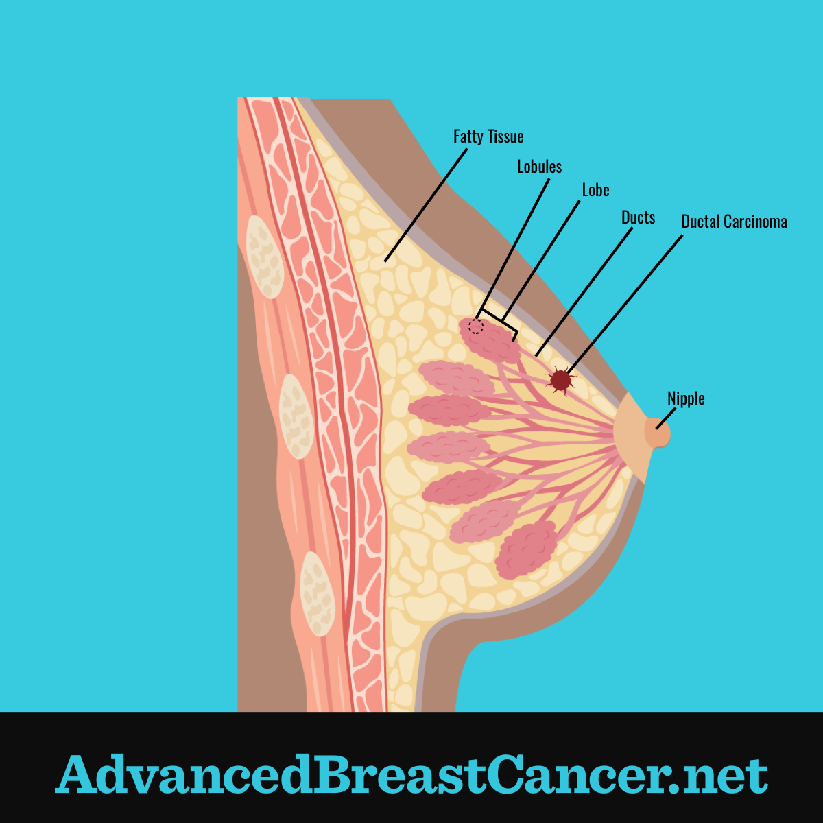 Ductal carcinoma shown in section of fatty tissue along a breast duct positioned between lobes and nipple.