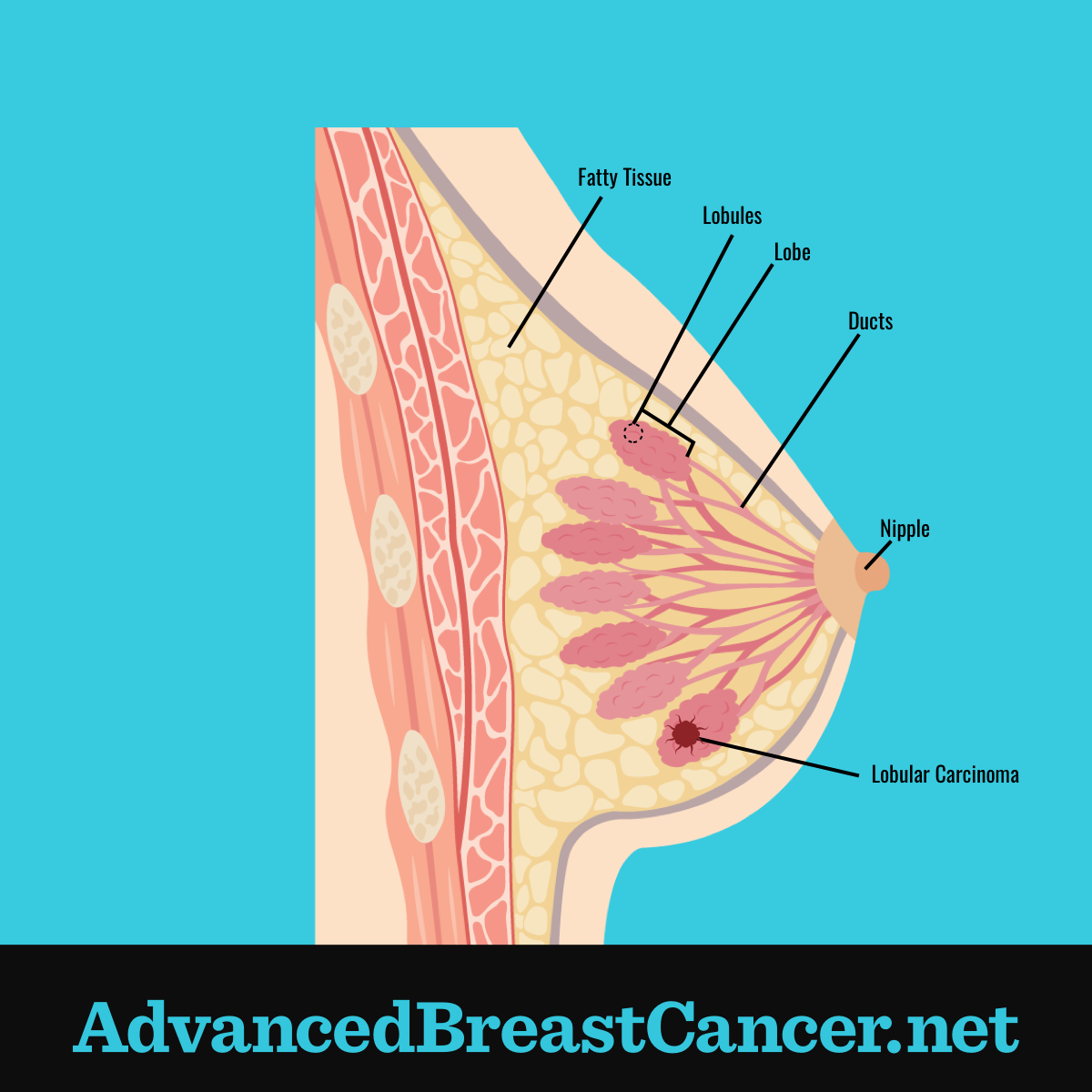 Lobular carcinoma shown in section of fatty tissue in a breast lobe with the ducts leading to the nipple.