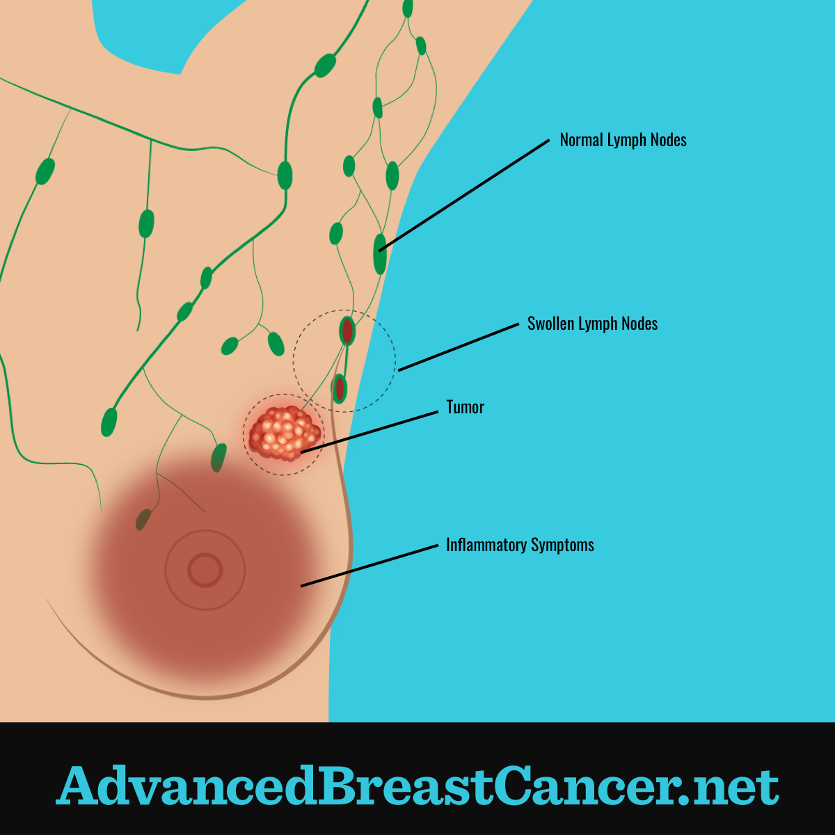 Tumor shown in breast with inflammatory symptoms including adjacent swollen lymph nodes, and the array of normal lymph nodes.