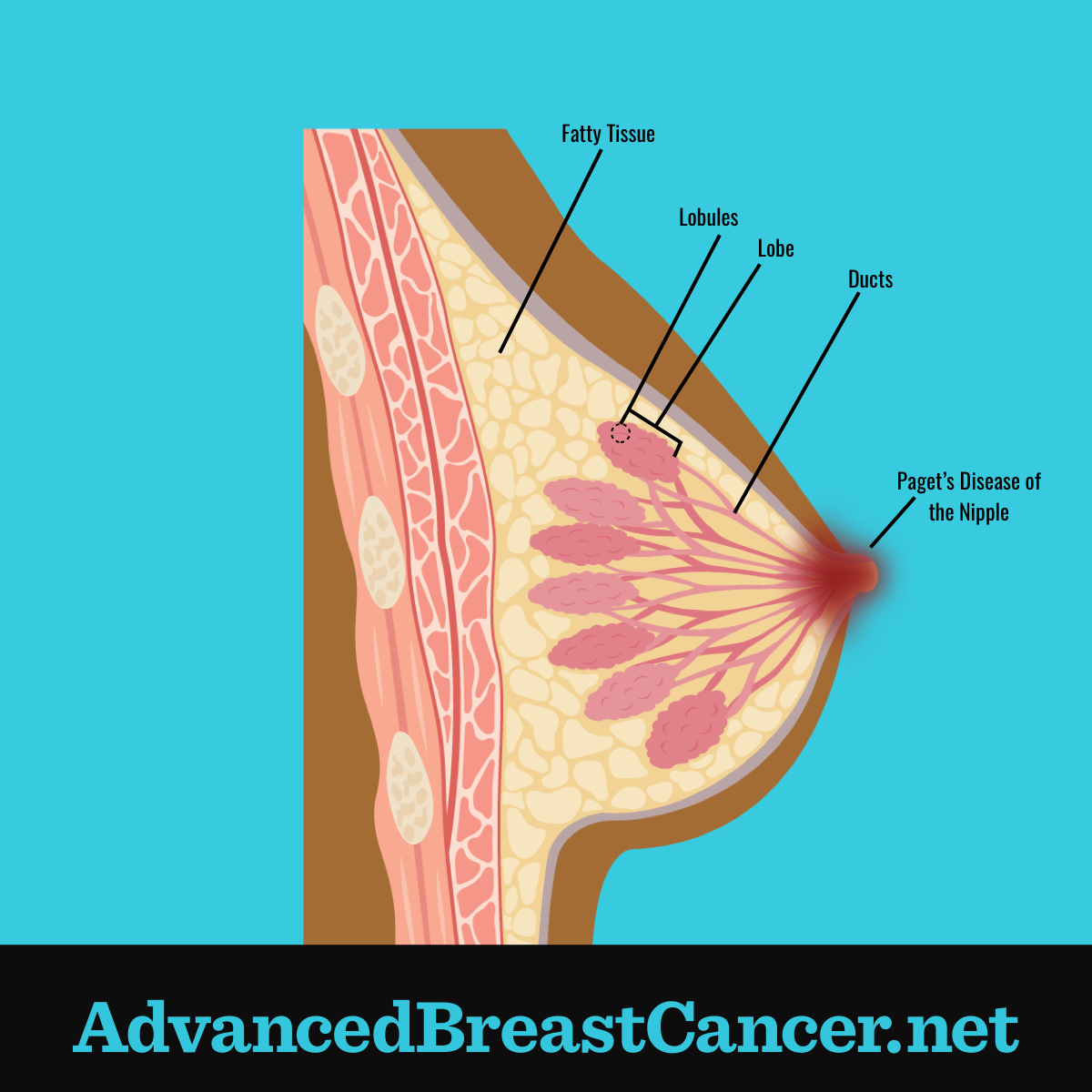 Pagets Disease of the nipple shown with cancer cells collected in or around the nipple.