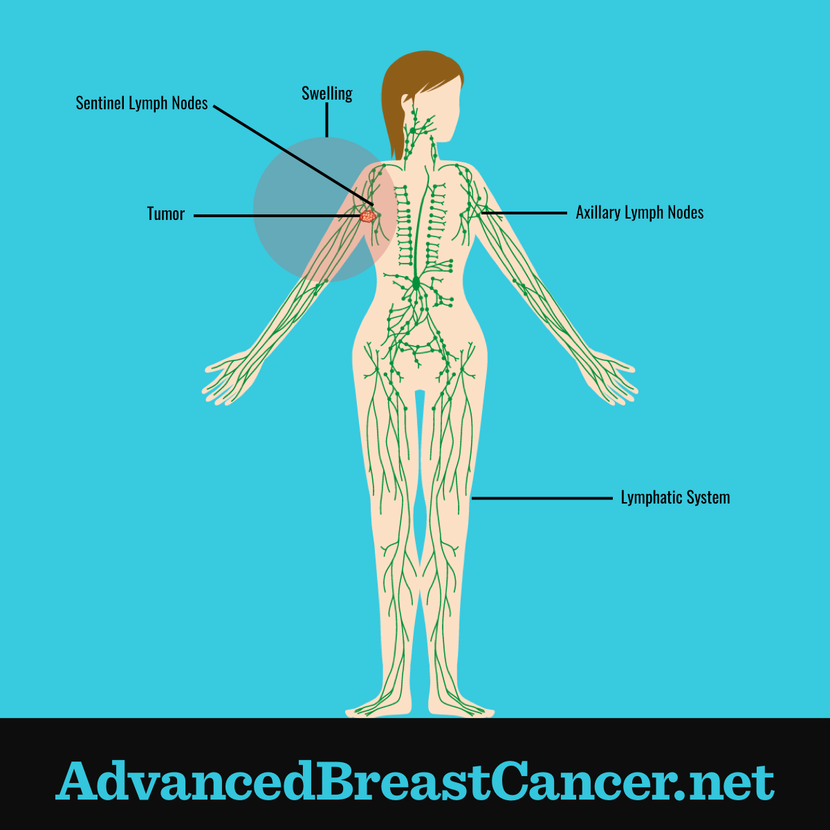 What Is Lymphedema in Metastatic Breast Cancer?