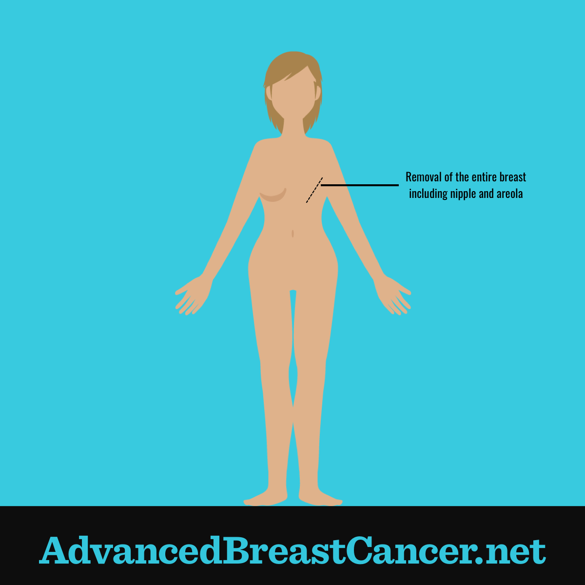 Human figure showing the right breast including the nipple and areola have been removed and has a large scar.