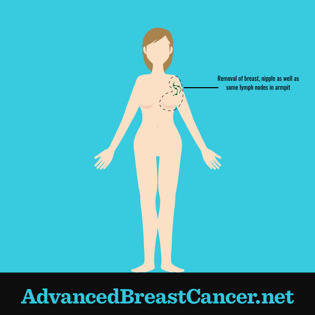 Human figure showing the right breast including skin, nipple, areola, and many axillary lymph nodes are removed.