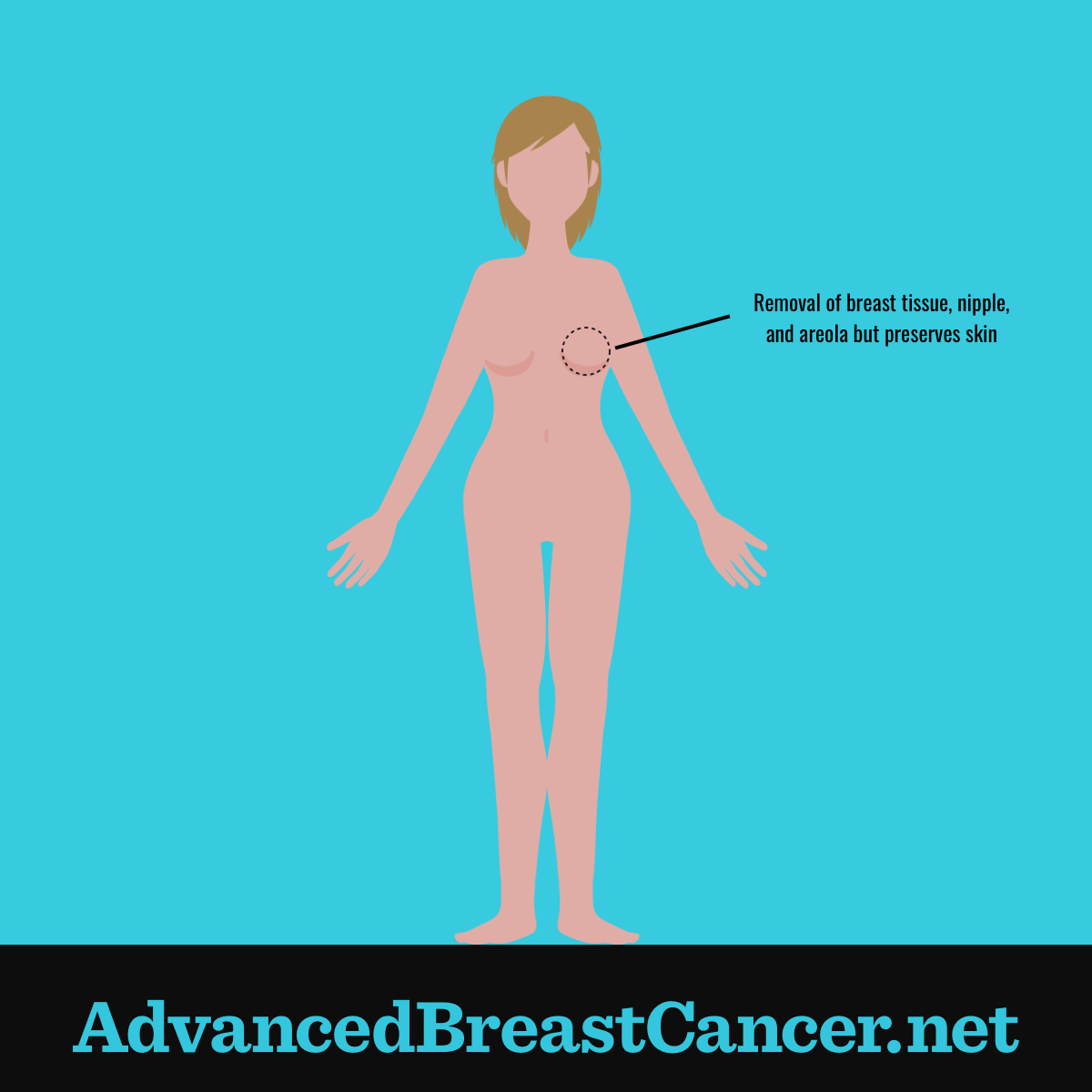 Human figure showing the right breast tissue, nipple and areola have been removed while the breast skin has been preserved.