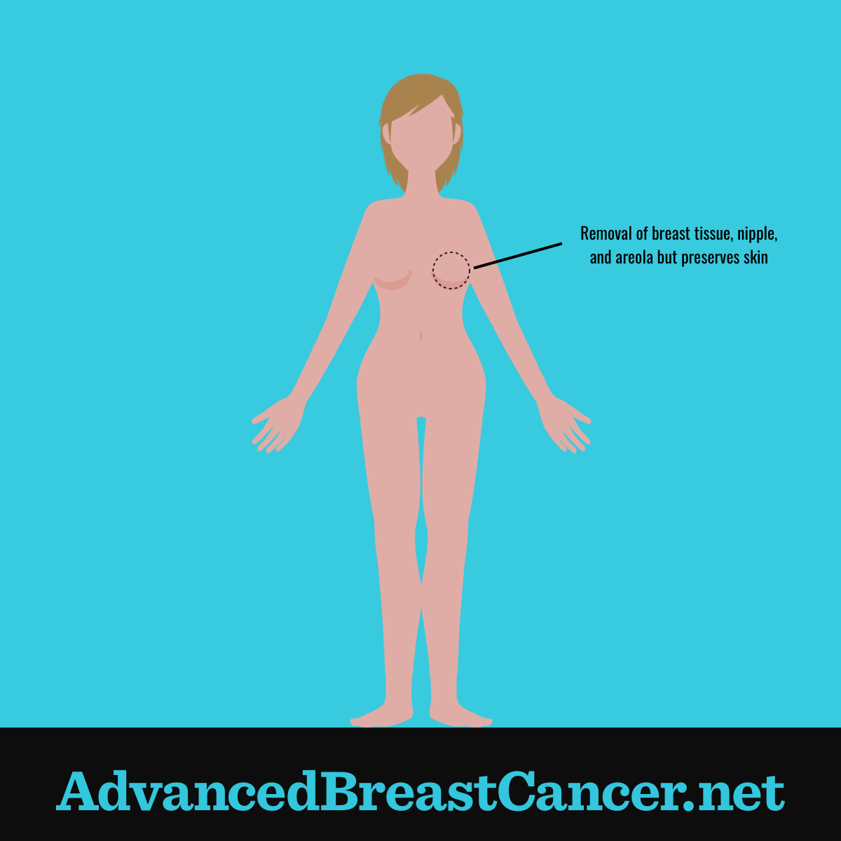 Skin-Sparing Mastectomy