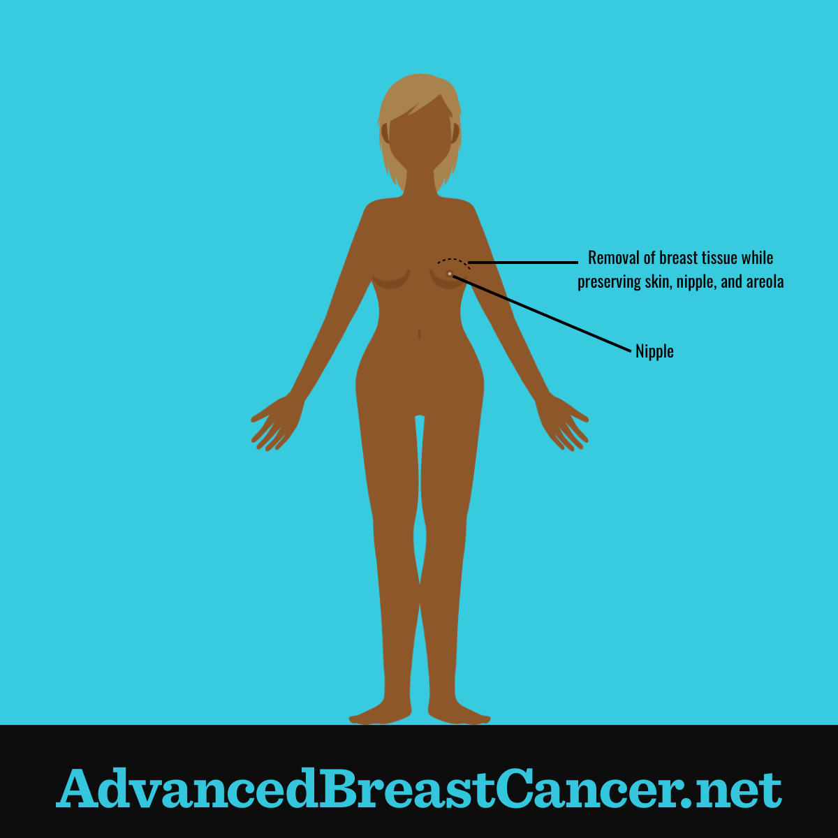Human figure showing the right breast tissue has been removed but the nipple, areola and breast skin have been preserved.