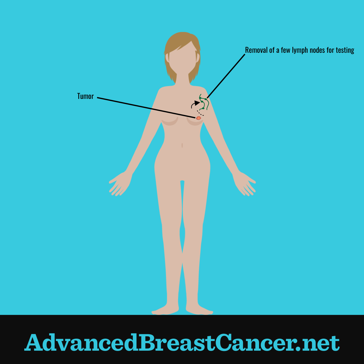 Sentinel Lymph Node Biopsy