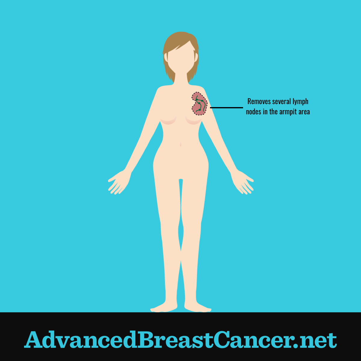 Human figure showing the removal many lymph nodes in the armpit area for testing.