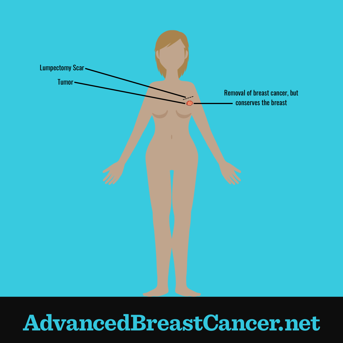 Human figure showing for this surgery the tumor is removed, the breast is conserved and a small scar is at the top of the breast.