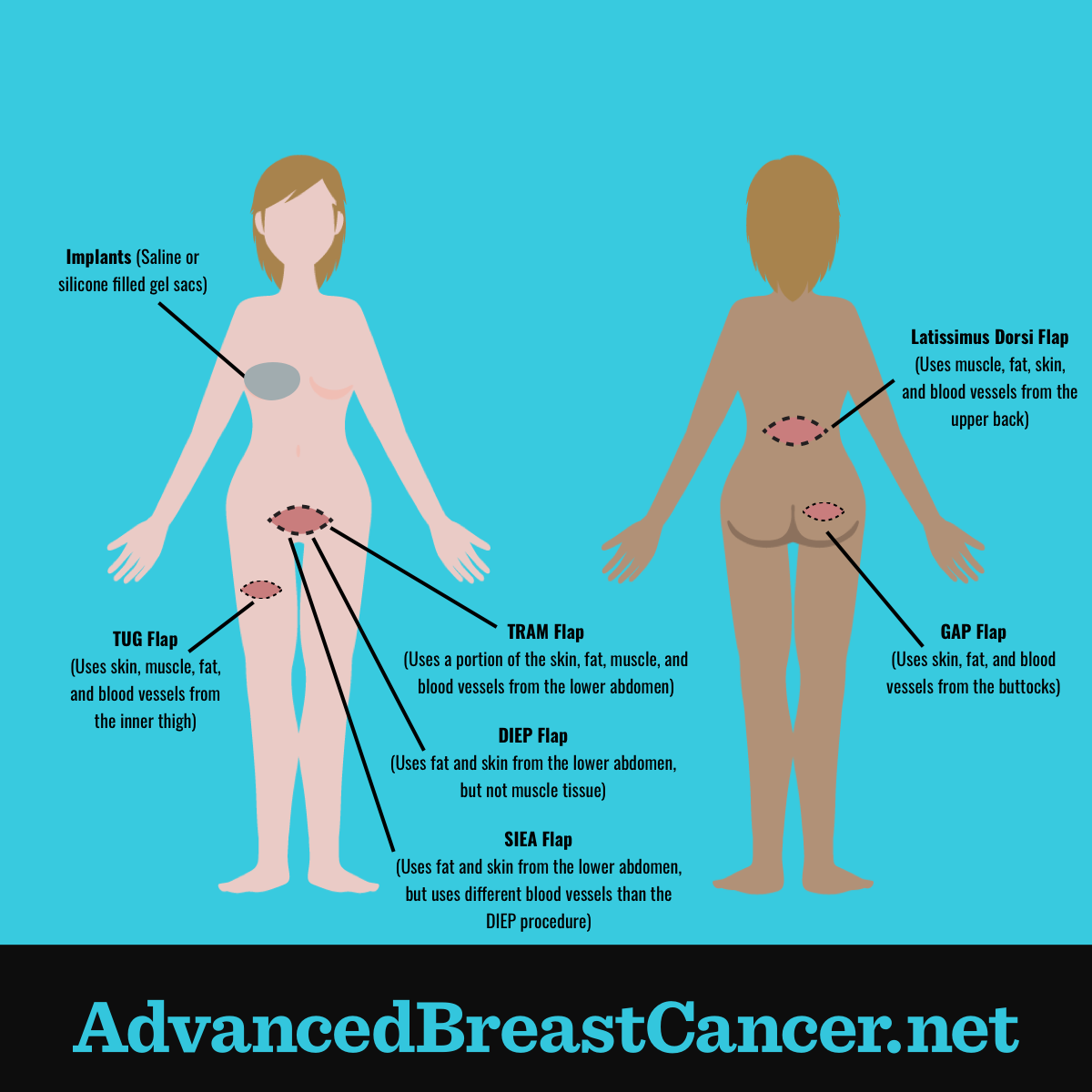 Human figure showing the different implant or flap reconstruction surgical options after a mastectomy.