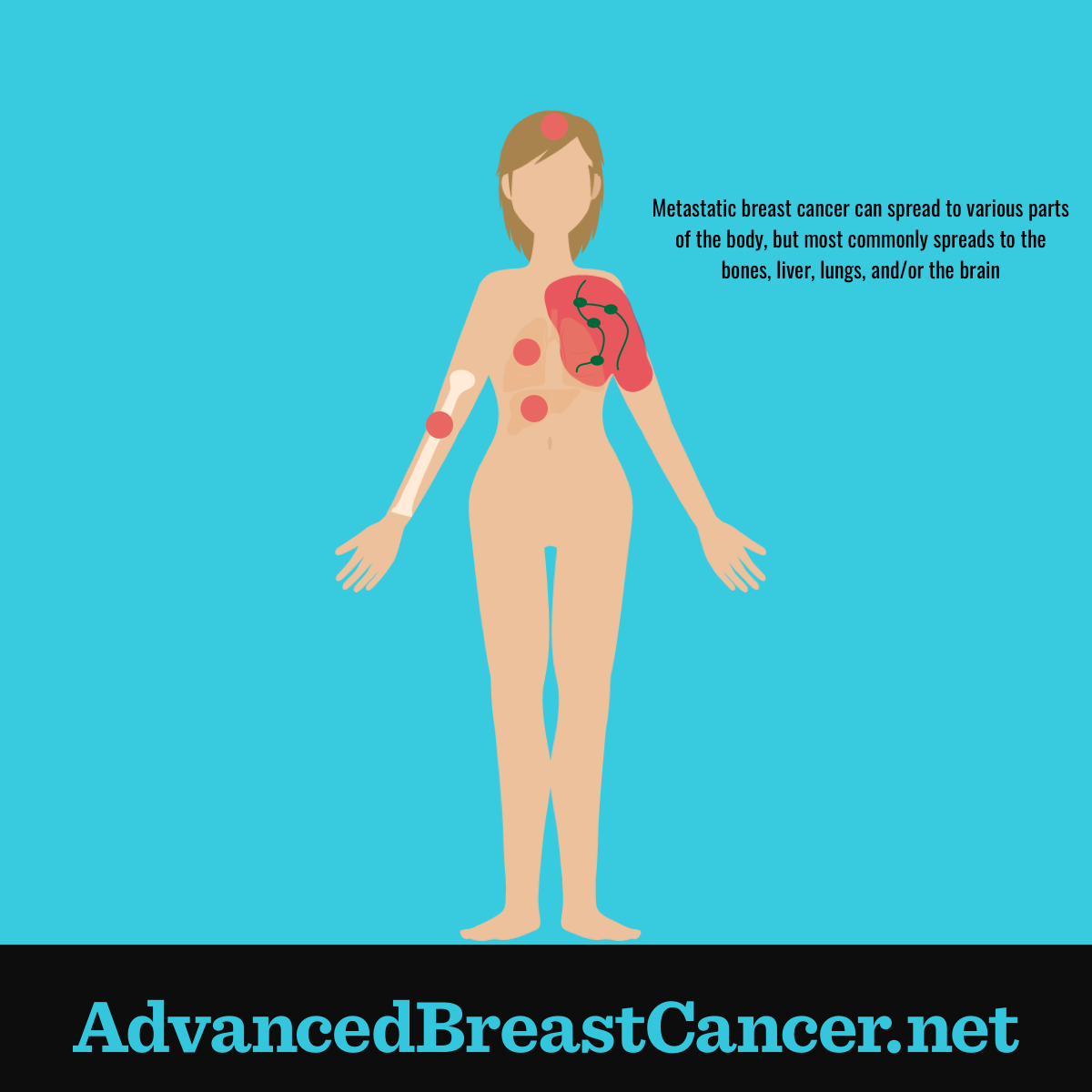 Human figure showing tumors in common locations of breast cancer metastasis including bones, liver, lungs and brain.