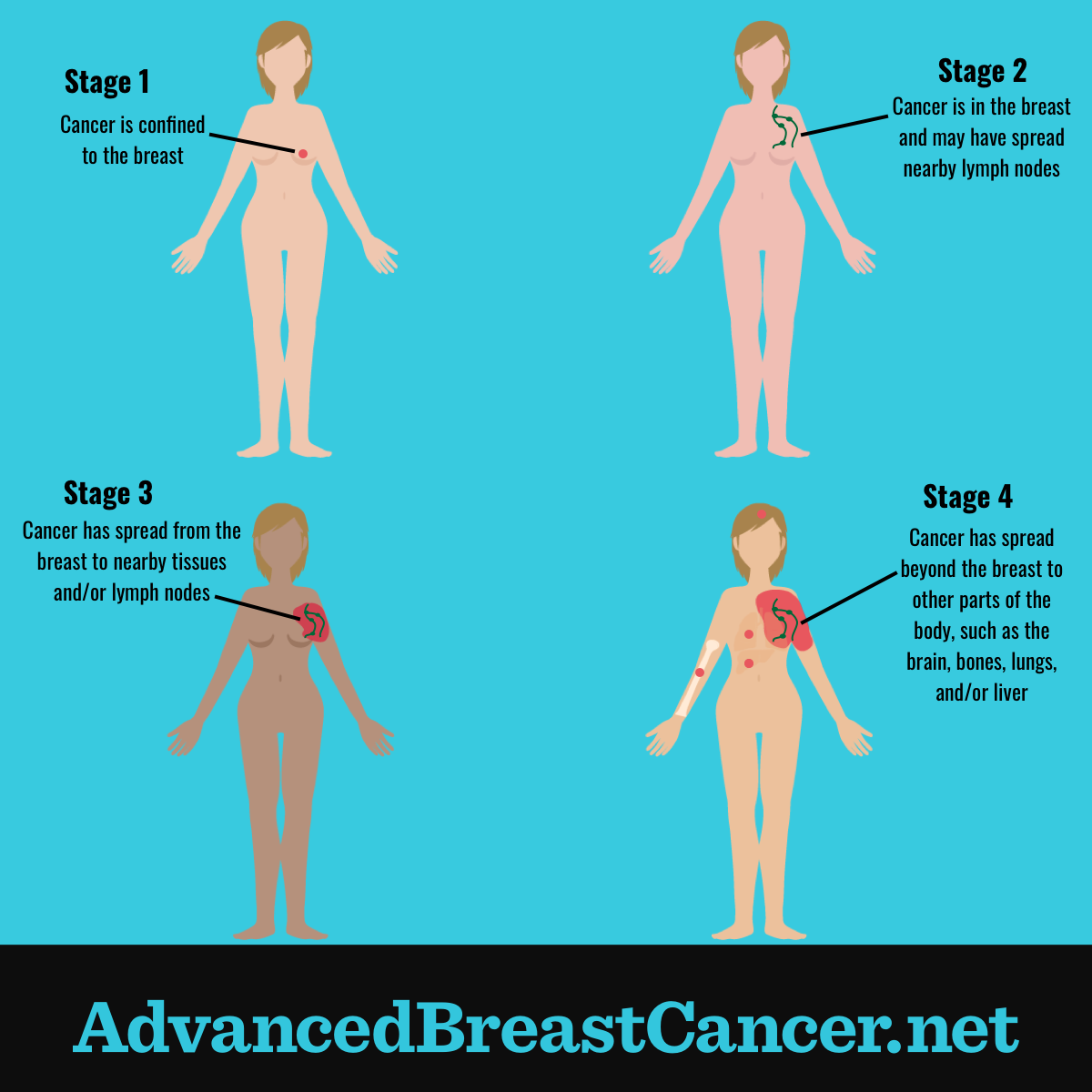 Breast Cancer Stages 0, 1, 2, 3 and 4