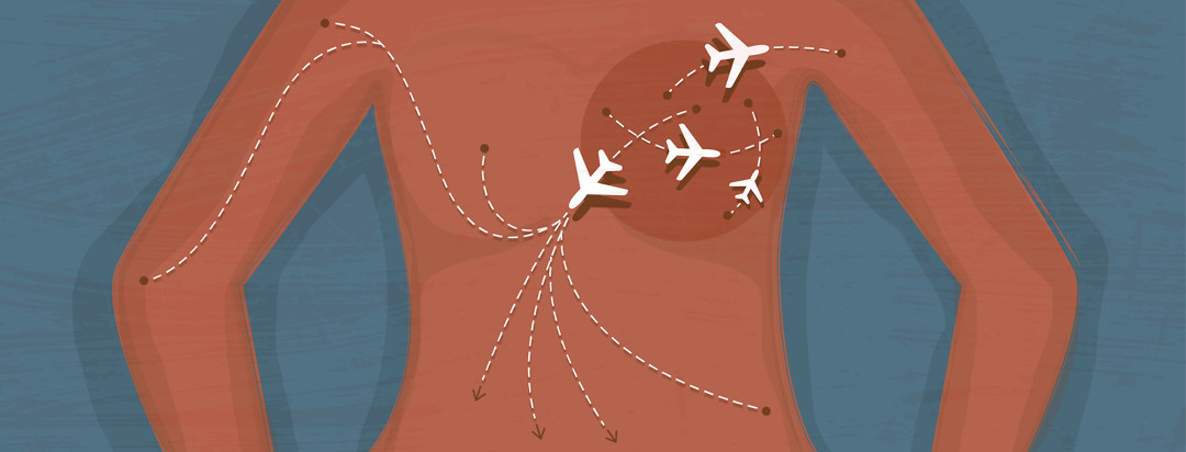 The top of a torso is shown with a darker circle around a breast, with four planes coming from that area to various parts of the body.