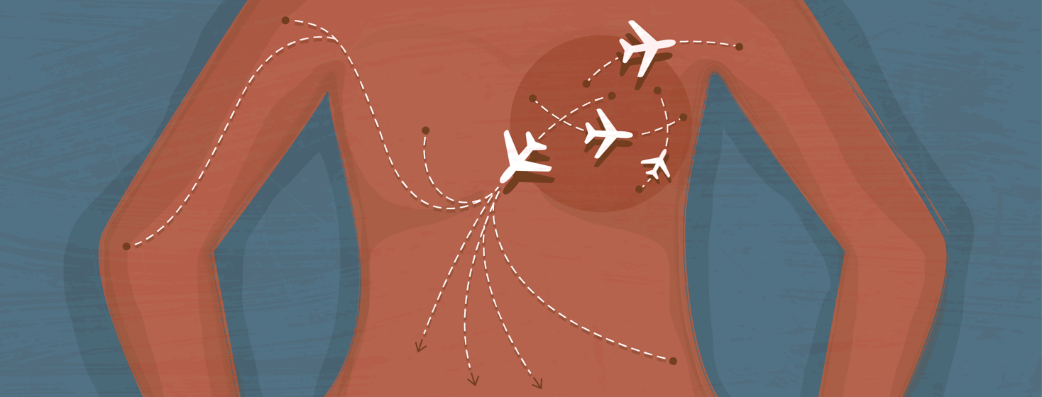The top of a torso is shown with a darker circle around a breast, with four planes coming from that area to various parts of the body.