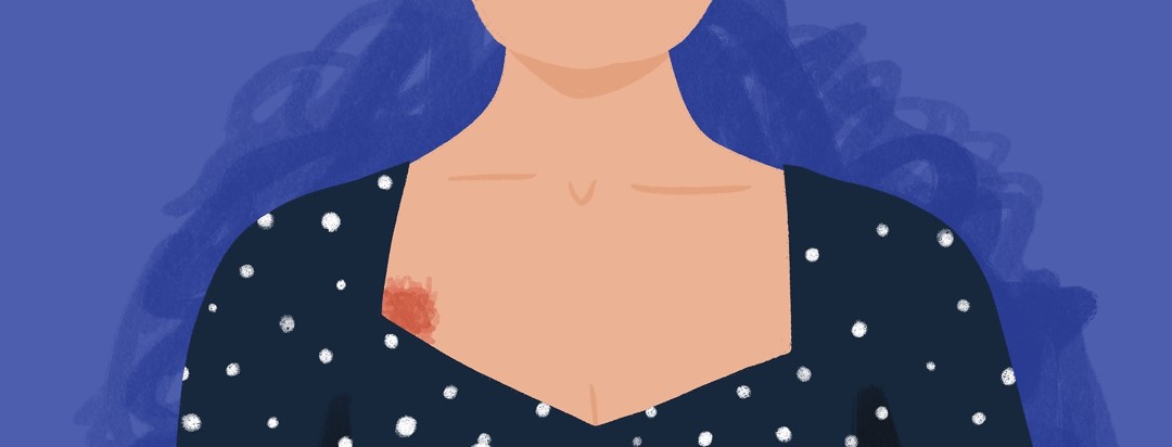 A woman wearing a nice dress is shown having a bruise-like spot on her chest for her chemo port