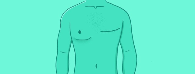 Male Breast Reconstruction: Fixed or Flat? image