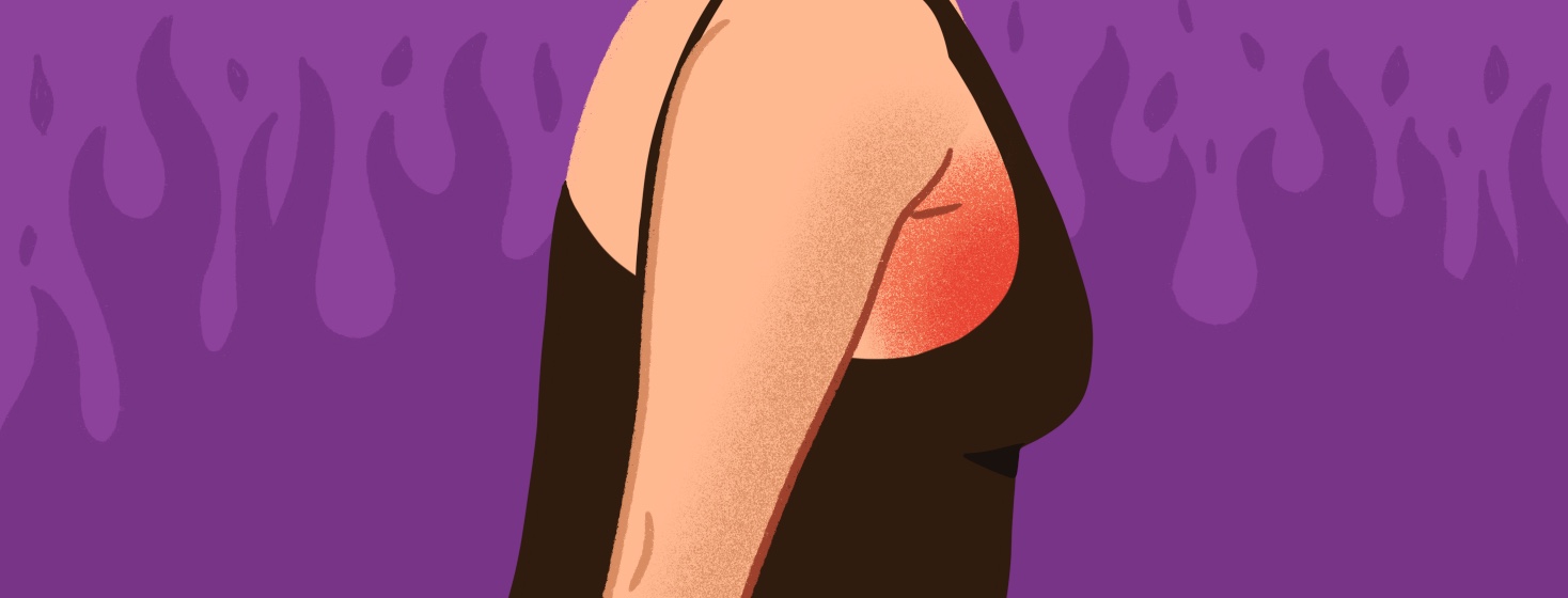 A female torso with radiation burn and redness around the breast area